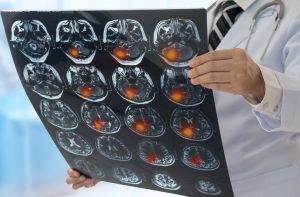 Newton Traumatic Brain Injury Accident Attorney Recovers Compensation