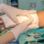 injured hand being treated for burns