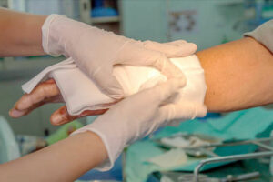 injured hand being treated for burns